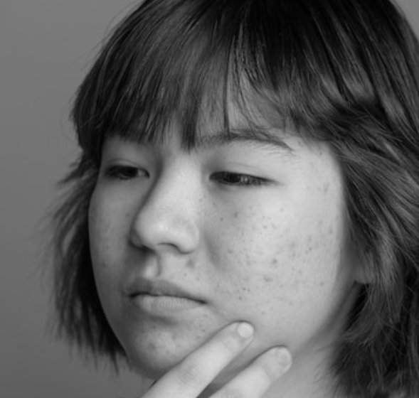 Acne and Pigmented Skin